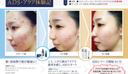 ADS・アクア体験記