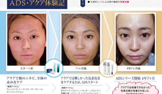 ADS・アクア体験記