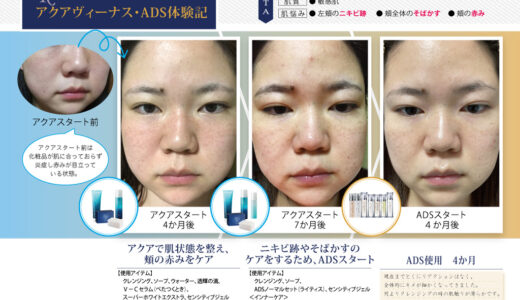 ADS・アクア体験記