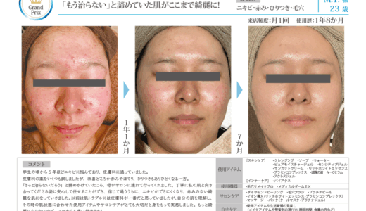 Recella Diva＆アクアヴィーナス症例