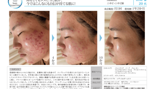 Recella Diva＆アクアヴィーナス症例