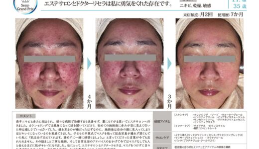 Recella Diva＆アクアヴィーナス症例