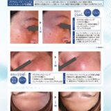 2509_HM9月_【A4】リヴァイブスキン症例POPのサムネイル